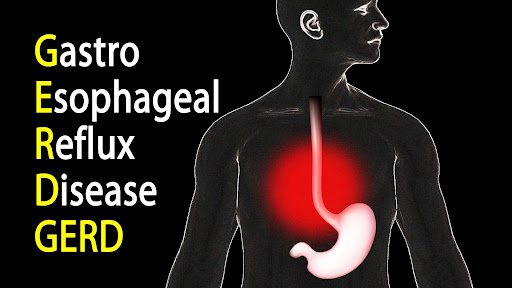 Gastroesophageal Reflux Disease​